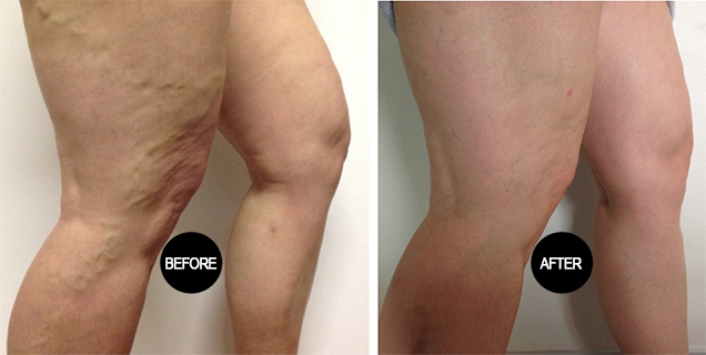 Varicose vein treatment result 1