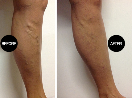 Varicose vein treatment result 6