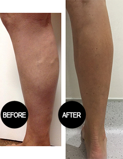 Varicose vein treatment result 4