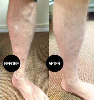 Varicose vein treatment result 5
