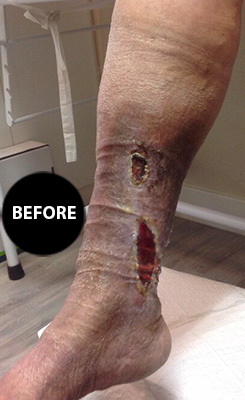 Varicose veins before treatment, patient 3