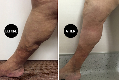 Varicose vein treatment result 2