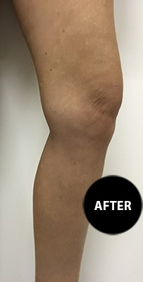 Varicose veins after treatment, patient 2