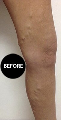 Varicose veins before treatment, patient 2