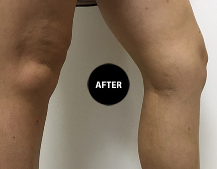 Varicose veins after treatment, patient 1