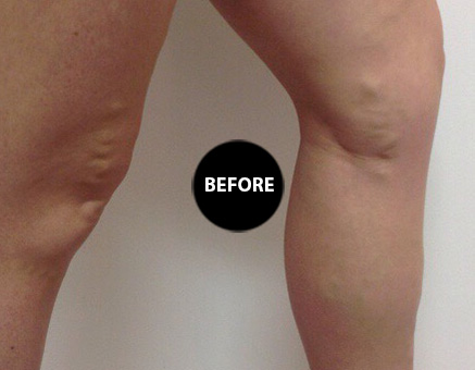 Varicose veins before treatment, patient 1
