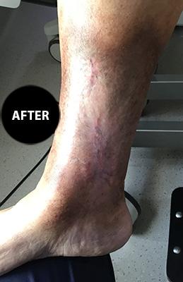 Varicose veins after treatment, patient 3