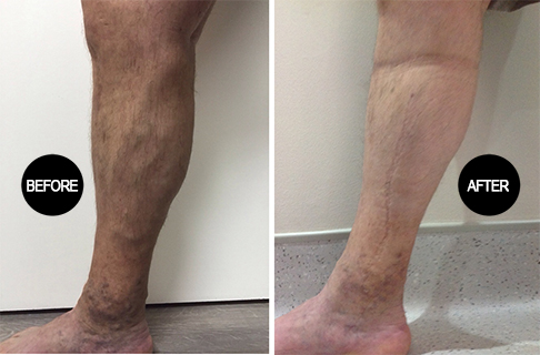 Varicose vein treatment result 3