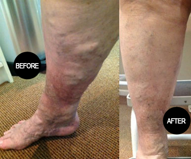Varicose vein treatment result 7