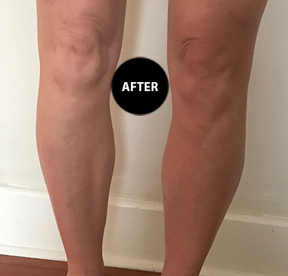 Varicose veins after treatment, patient 4