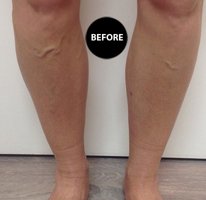 Varicose veins before treatment, patient 4